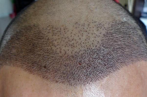 植发要多少钱一般 植发可以维持多久 植发要多少钱一般 植发可以维持多久