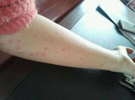 什么样的红点是艾滋病?艾滋病一开始的皮肤是怎样的图片