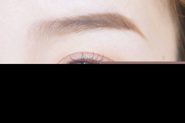 双眼皮埋线后怎么消肿 双眼皮埋线后需要吃消炎药吗