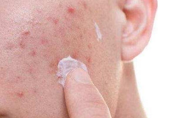 痘痘肌肤怎么修复 痘痘肌肤适合用什么牌子的护肤品