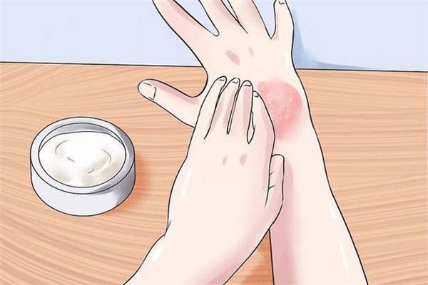 冻疮可以涂红霉素软膏吗 冻疮涂芦荟胶有用吗 冻疮可以涂红霉素软膏吗 冻疮涂芦荟胶有用吗