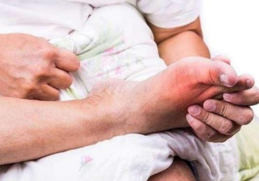 有人尿酸高几十年都没事是真的吗?尿酸高的人寿命都短吗